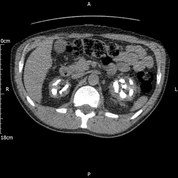 File:Bilateral medullary nephrocalcinosis with ureteric calculi (Radiopaedia 71269-81569 Axial non-contrast 36).jpg