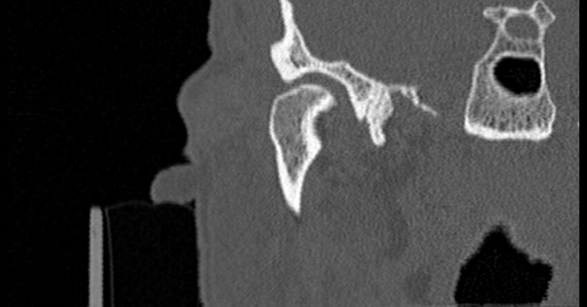 Bilateral temporal bone fractures (Radiopaedia 29482-29970 Coronal non-contrast 49).jpg