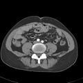 Biliary necrosis - liver transplant (Radiopaedia 21876-21845 A 43).jpg