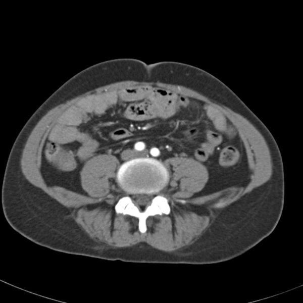 File:Biliary necrosis - liver transplant (Radiopaedia 21876-21845 A 43).jpg