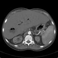 Biliary necrosis - liver transplant (Radiopaedia 21876-21846 A 21).jpg