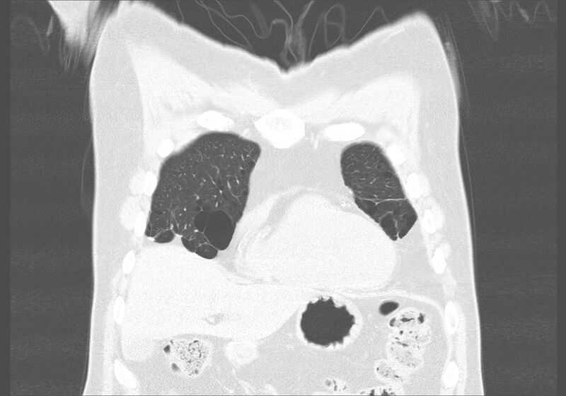 File:Birt-Hogg-Dubé syndrome (Radiopaedia 52578-58491 Coronal lung window 5).jpg