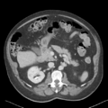 Bladder papillary urothelial carcinoma (Radiopaedia 48119-52951 Axial 18).png