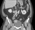 Bladder papillary urothelial carcinoma (Radiopaedia 48119-52951 C 36).png