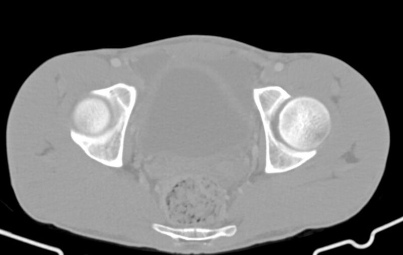 File:Blunt injury to the small bowel (Radiopaedia 74953-85987 Axial Wide 89).jpg
