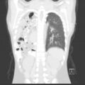Bochdalek diaphragmatic hernia (Radiopaedia 38866-41059 Coronal lung window 16).jpg