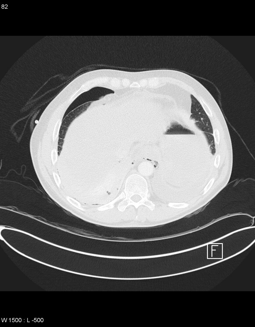 Boerhaave syndrome with tension pneumothorax (Radiopaedia 56794-63605 Axial lung window 40).jpg