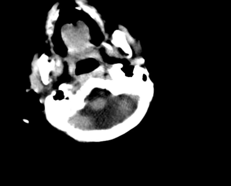 File:Brachycephaly (bi-coronal and bi-lambdoid synostosis) (Radiopaedia 55048-61413 Axial non-contrast 6).jpg