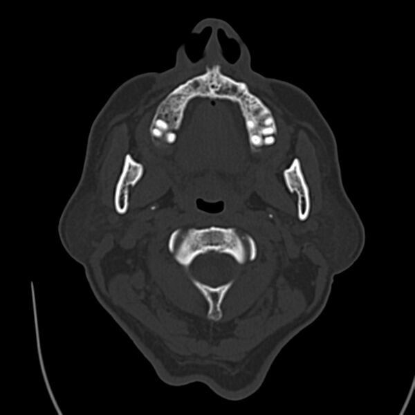 File:Brain Pantopaque remnants (Radiopaedia 78403-91048 Axial bone window 4).jpg