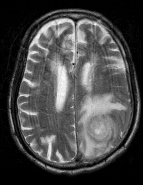 File:Brain abscess with dual rim sign (Radiopaedia 87566-103938 Axial T2 16).jpg