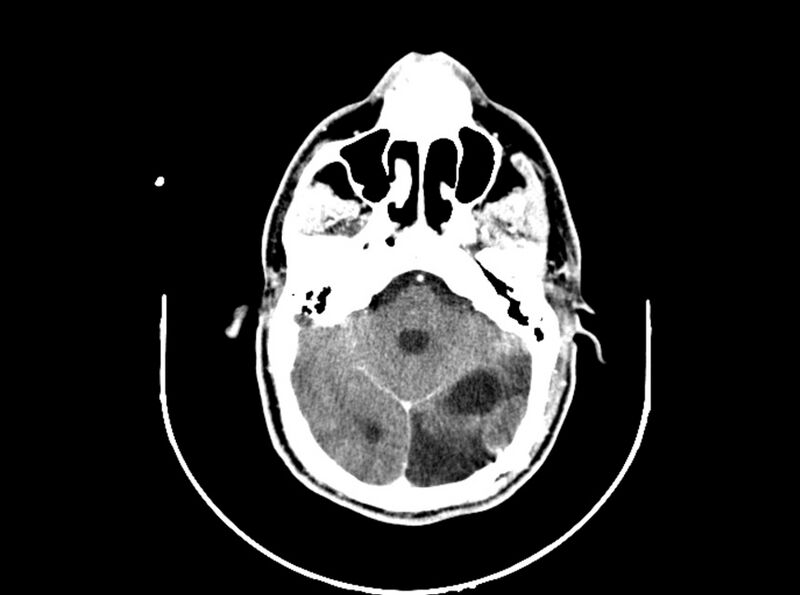 File:Brain injury by firearm projectile (Radiopaedia 82068-96088 B 92).jpg