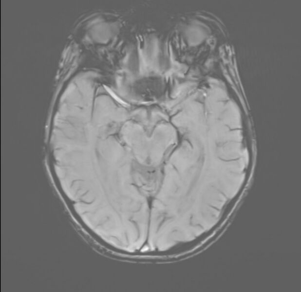 File:Brainstem glioma (Radiopaedia 70548-80674 Axial SWI 25).jpg