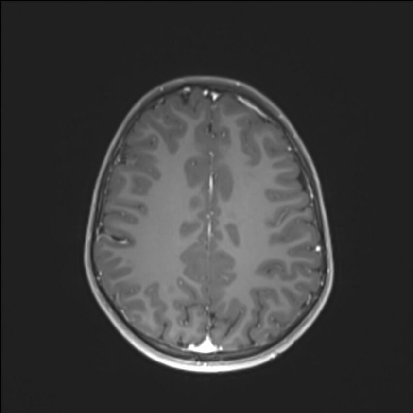 Brainstem glioma (Radiopaedia 70548-80674 Axial T1 C+ 110).jpg