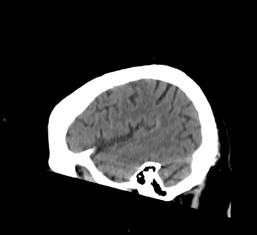 Brainstem hemorrhage (Radiopaedia 58794-66028 C 41).jpg