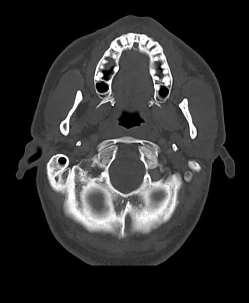 File:Branchial cleft cyst (Radiopaedia 31167-31875 Axial bone window 15).jpg