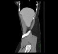 Broad ligament hernia (Radiopaedia 63260-71832 C 7).jpg