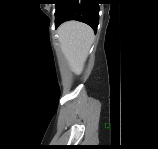 File:Broad ligament hernia (Radiopaedia 63260-71832 C 7).jpg