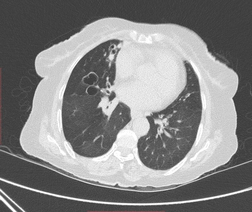 Bronchiectasis (Radiopaedia 72693-83293 Axial lung window 80).jpg