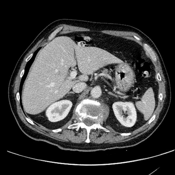 File:Bronchogenic carcinoma with L1 vertebra metastasis (Radiopaedia 9096-9805 Axial C+ delayed 37).jpg