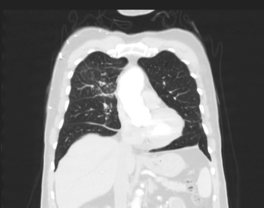 Bronchogenic carcinoma with lymphangitic spread (Radiopaedia 29002-29357 Coronal lung window 23).jpg