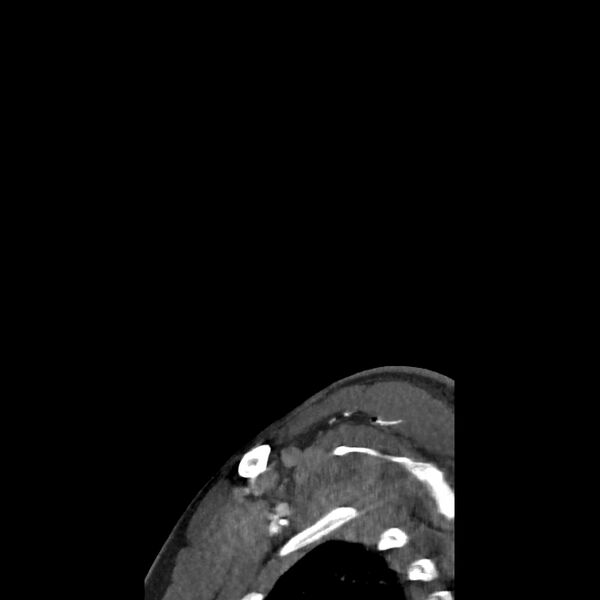 File:Buccal fat pad arteriovenous malformation (Radiopaedia 70936-81144 C 80).jpg
