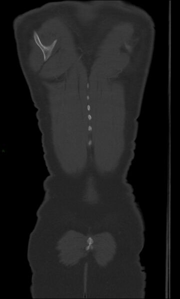 File:Burst fracture (Radiopaedia 83168-97542 Coronal bone window 69).jpg
