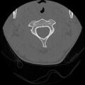 C5 facet fracture (Radiopaedia 58374-65499 Axial bone window 24).jpg