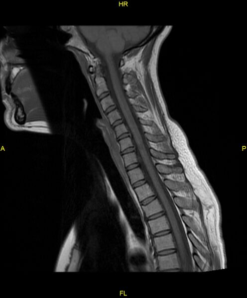 File:C5 nerve sheath tumor (Radiopaedia 85777-101596 Sagittal T1 10).jpg
