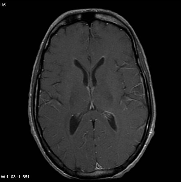 File:CMV ventriculitis and encephalitis (Radiopaedia 5416-7166 Axial T1 C+ 5).jpg