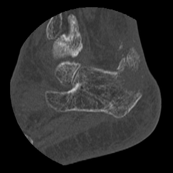 File:Calcaneal tuberosity avulsion fracture (Radiopaedia 22649-22668 D 7).jpg
