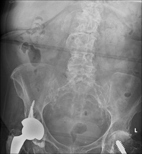 File:Calcified abdominal aortic aneurysm (Radiopaedia 78019).jpg