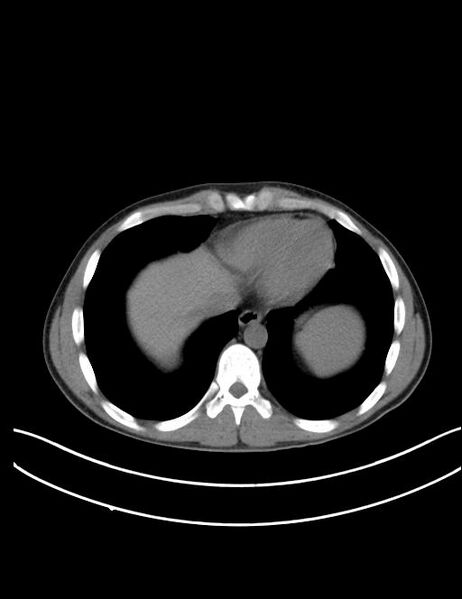 File:Calcifying pulmonary metastases (Radiopaedia 33359-34396 Axial non-contrast 24).jpg