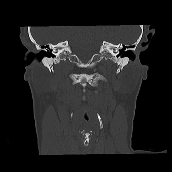 File:Canal up mastoidectomy (Radiopaedia 78108-90638 Coronal bone window 34).jpg