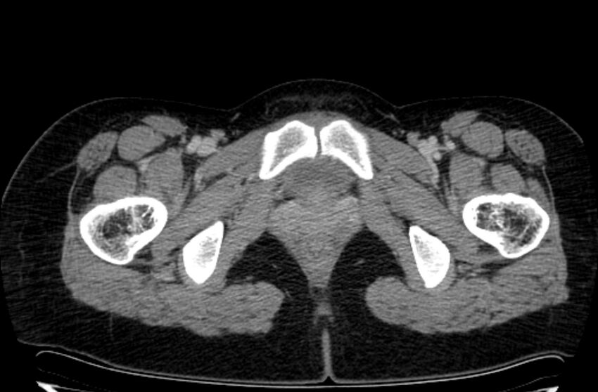 Cannonball metastases - uterine choriocarcinoma (Radiopaedia 70137-80174 A 64).jpg