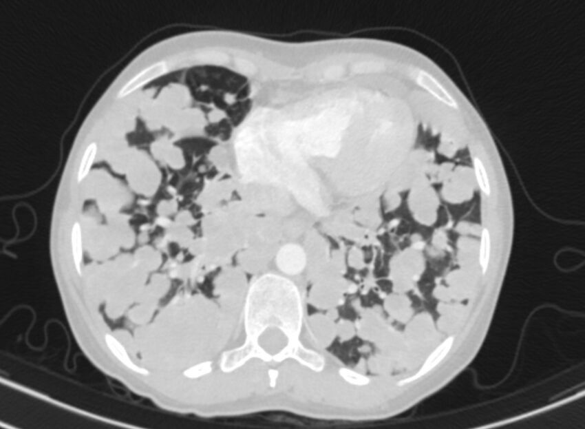 Cannonball metastases from breast cancer (Radiopaedia 91024-108569 Axial lung window 76).jpg