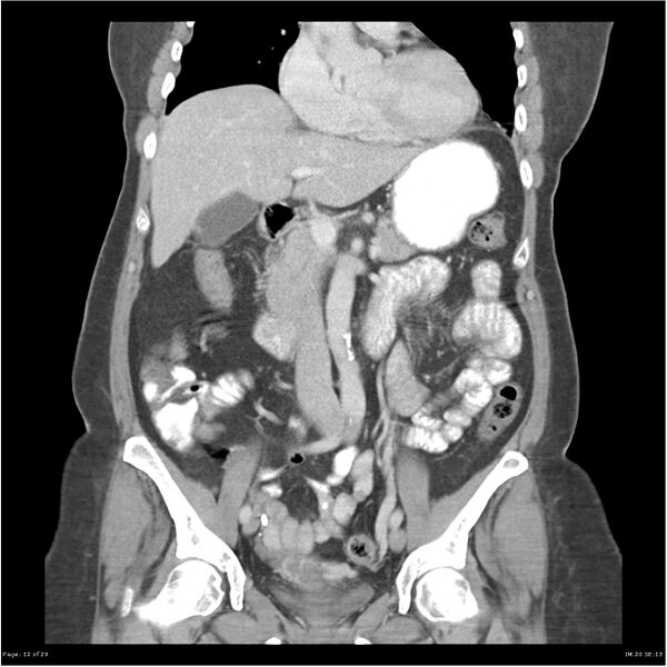 File:Carcinoid tumor of the ileum with metastasis to orbit (Radiopaedia 28165-28425 B 12).jpg