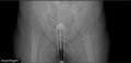 Carcinoma cervix- brachytherapy applicator (Radiopaedia 33135-34173 Scout 1).jpg