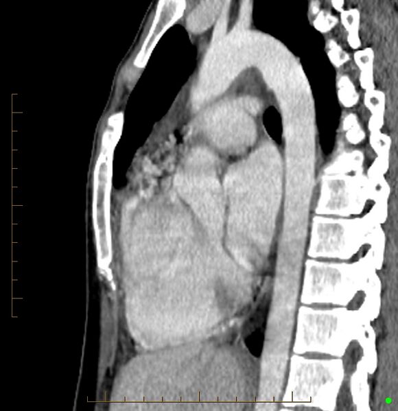 File:Cardiac paraganglioma (Radiopaedia 76345-88005 C 52).jpg