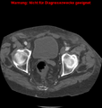 Cardiac perforation following transcatheter aortic valve implantation (Radiopaedia 23714-23863 B 4).png