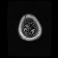 Caroticocavernous fistula (Radiopaedia 8617-9440 Axial T1 21).jpg