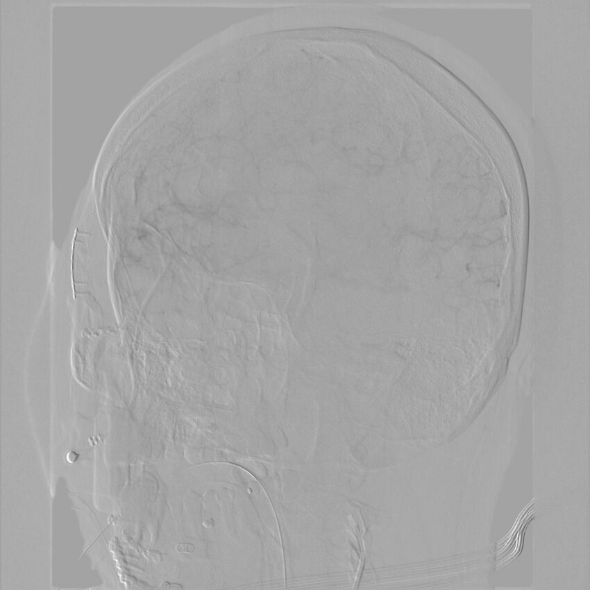 Caroticocavernous fistula - direct (Radiopaedia 61660-69666 Oblique Left ICA 33).jpg