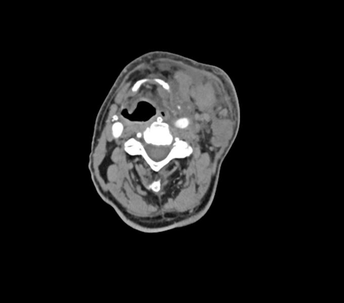 File:Carotid artery pseudoaneurysm (Radiopaedia 84030-99259 C 39).jpg