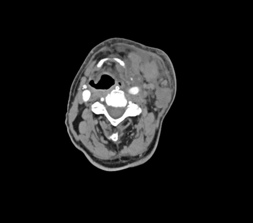 Carotid artery pseudoaneurysm (Radiopaedia 84030-99259 C 39).jpg