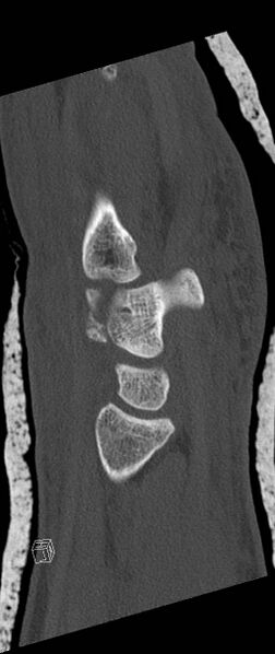 File:Carpal fractures (smart watch impaction) (Radiopaedia 55844-62430 Sagittal bone window 16).jpg