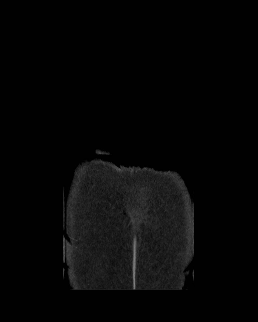 Cecal volvulus (Radiopaedia 54998-61310 B 65).jpg