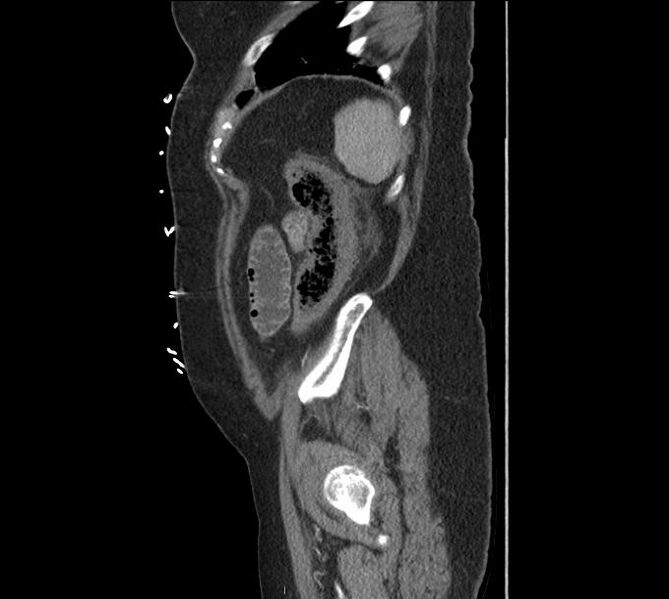 File:Celiac artery severe stenosis and dissection (Radiopaedia 44128-47842 A 6).jpg