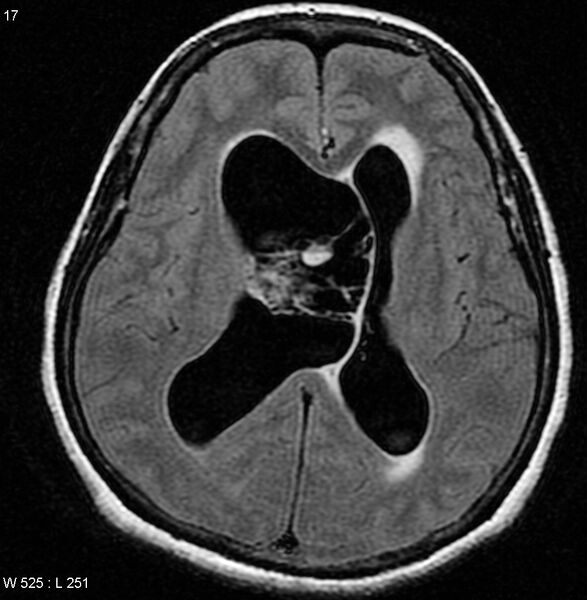 File:Central neurocytoma (Radiopaedia 4355-6613 Axial FLAIR 1).jpg