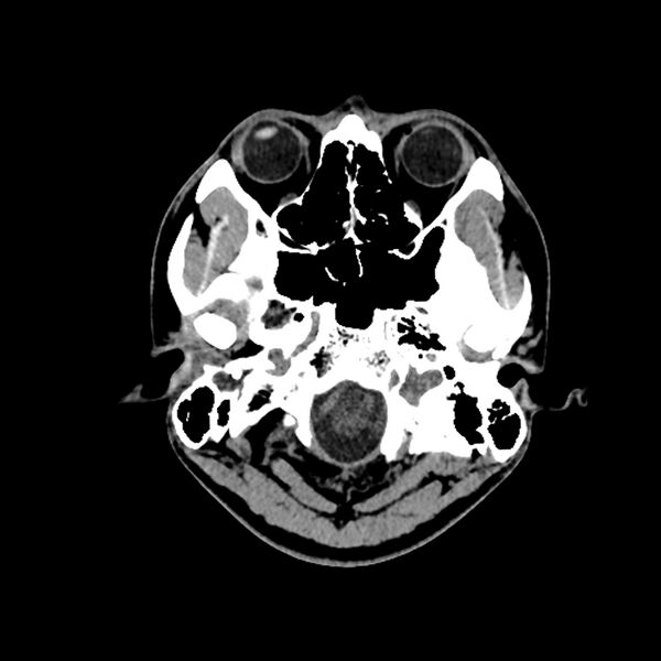 File:Central neurocytoma (Radiopaedia 79320-92379 Axial non-contrast 5).jpg
