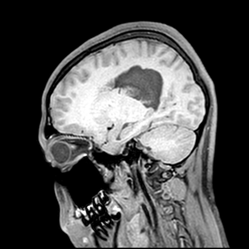 Central neurocytoma (Radiopaedia 79320-92380 Sagittal T1 172).jpg
