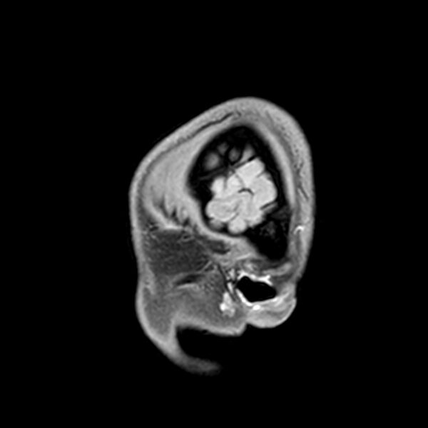 File:Central neurocytoma (Radiopaedia 79320-92380 Sagittal T1 22).jpg